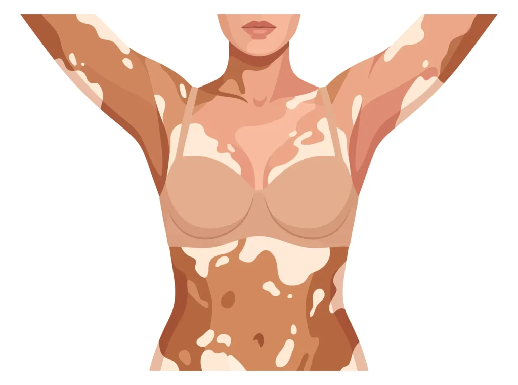 illustration of a woman with vitiligo skin condition